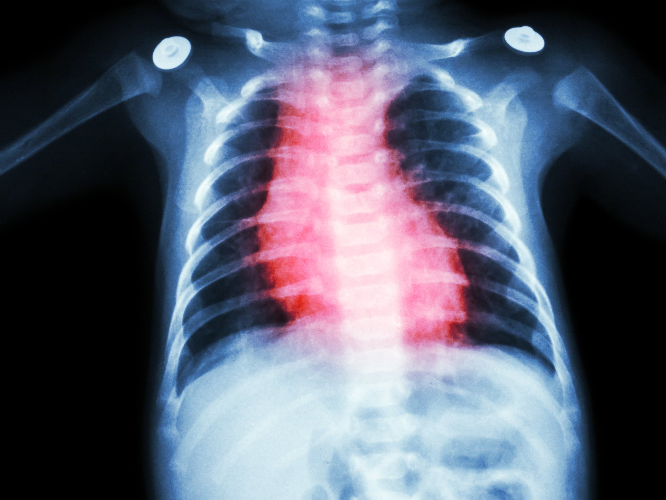 X-ray of hypoplastic left heart syndrome X-ray of hypoplastic left heart syndrome