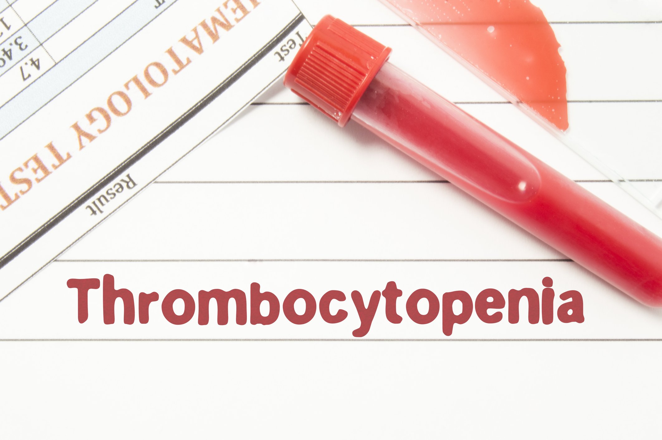 Blood sample for a thrombocytopenia test Blood sample for a thrombocytopenia test